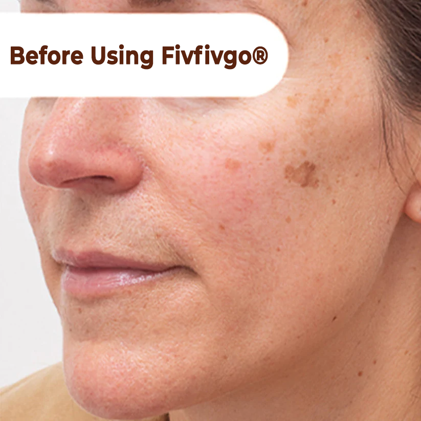 Mascarilla facial despegable Fivfivgo® Herbal Spots