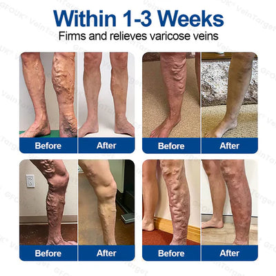VeinTarget Microneedling Patch