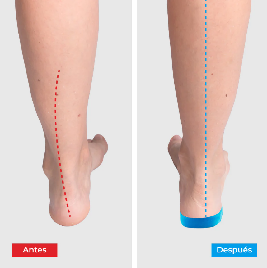 Plantillas ComfyFeet™️ - Disfruta de días sin dolor, sin tratamientos caros ni visitas al médico...