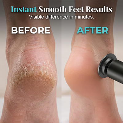 Rechargeable Electric Foot Callus Remover